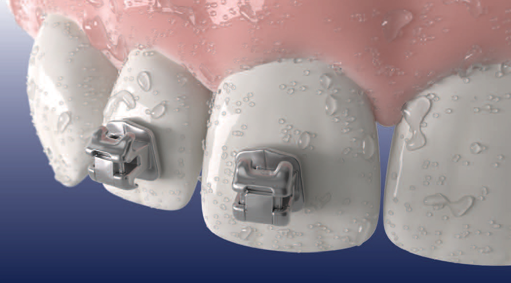 033 Metal or ceramic brackets